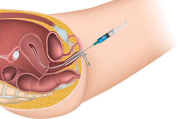 Understanding IUI Treatment Process