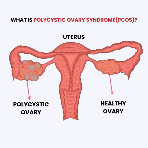 Best Fertility Treatments for Women with PCOS in 2026