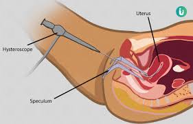 HSG Test in Sonipat: Procedure, Purpose & What to Expect